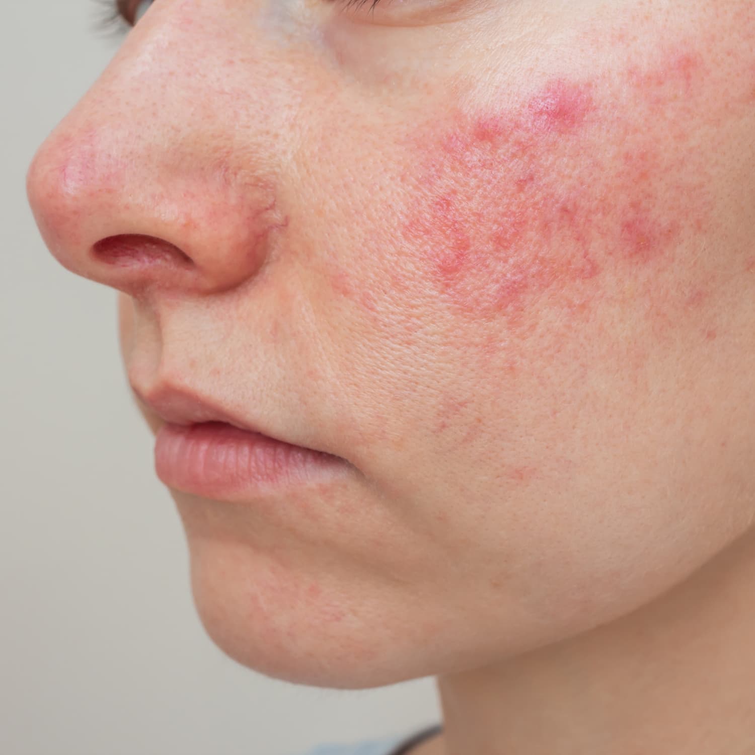Rosacea Fact Sheets Yale Medicine