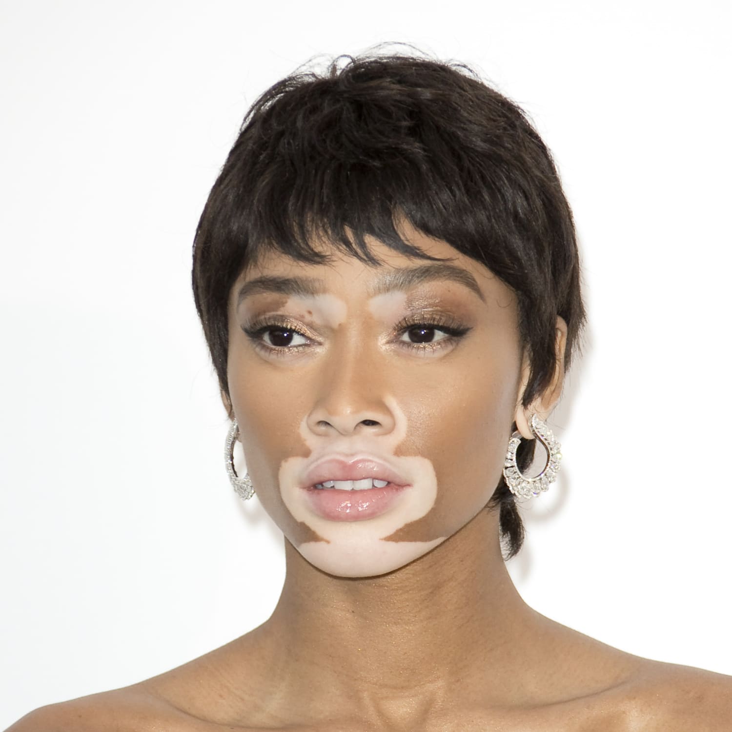 Vitiligo Fact Sheets Yale Medicine