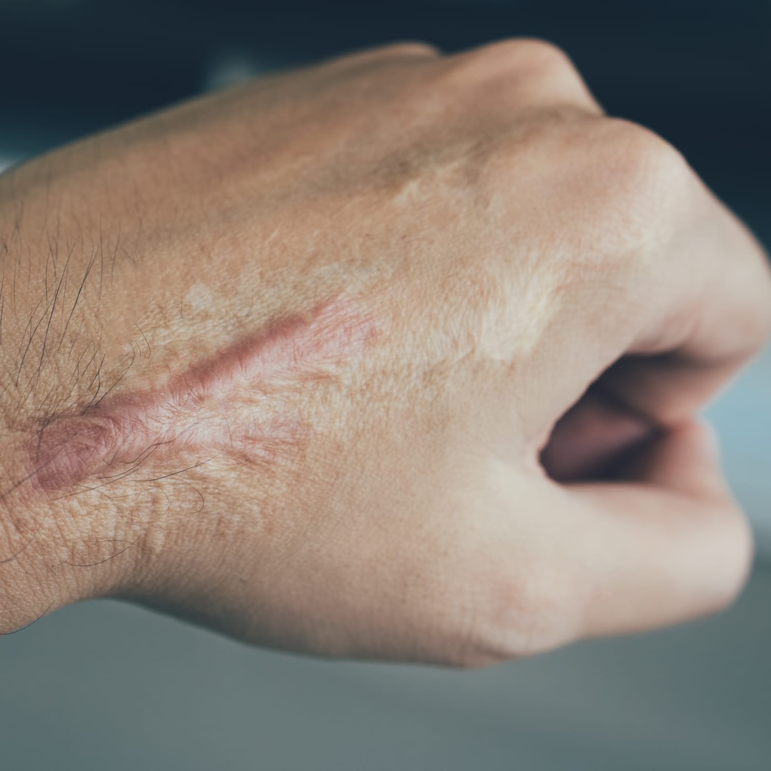 Hypertrophic Scar: Treatment, Causes, Image, and More