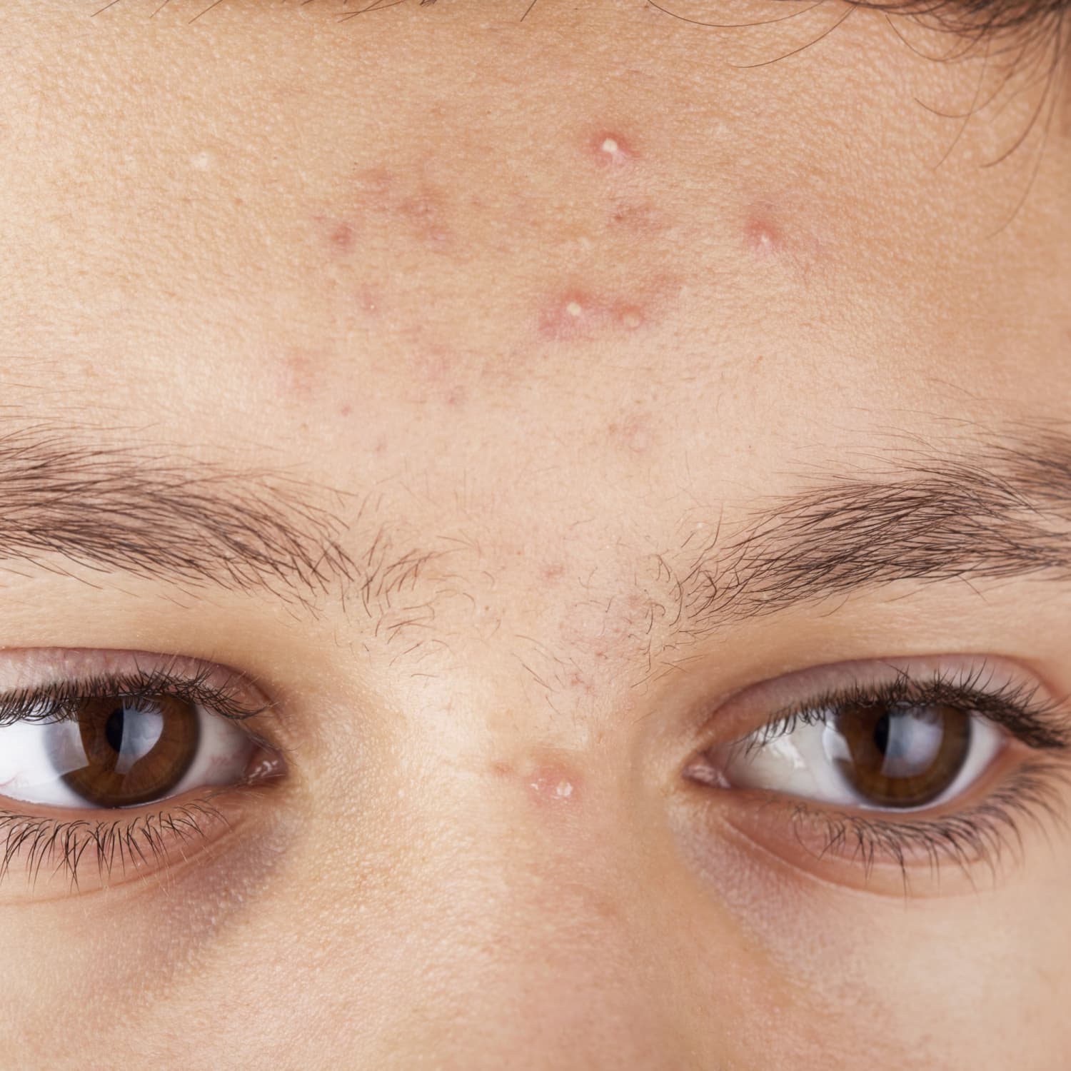 How rare is acne?