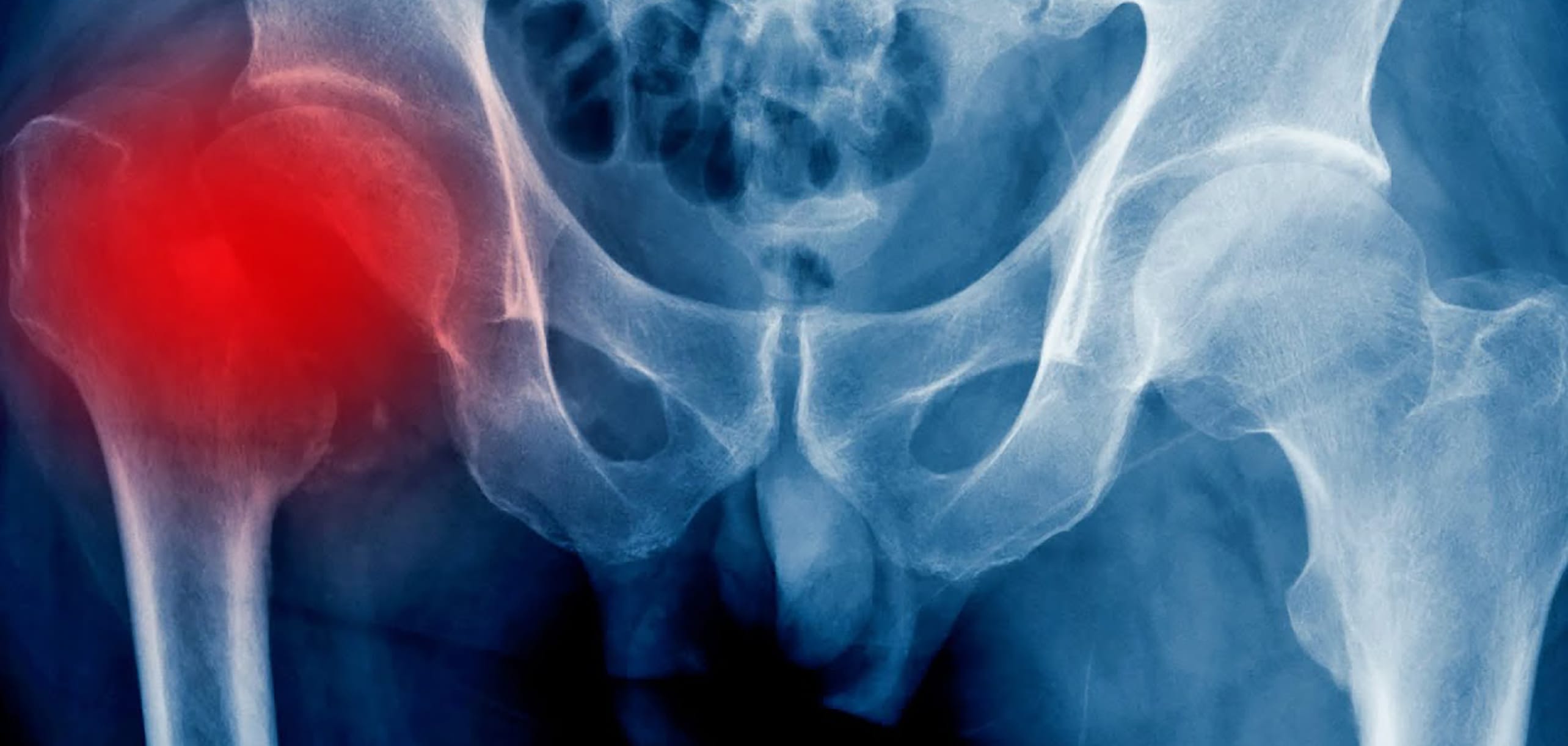 An X-ray image of a pelvis and upper femurs with a deep red circle overlaid on the left hip joint