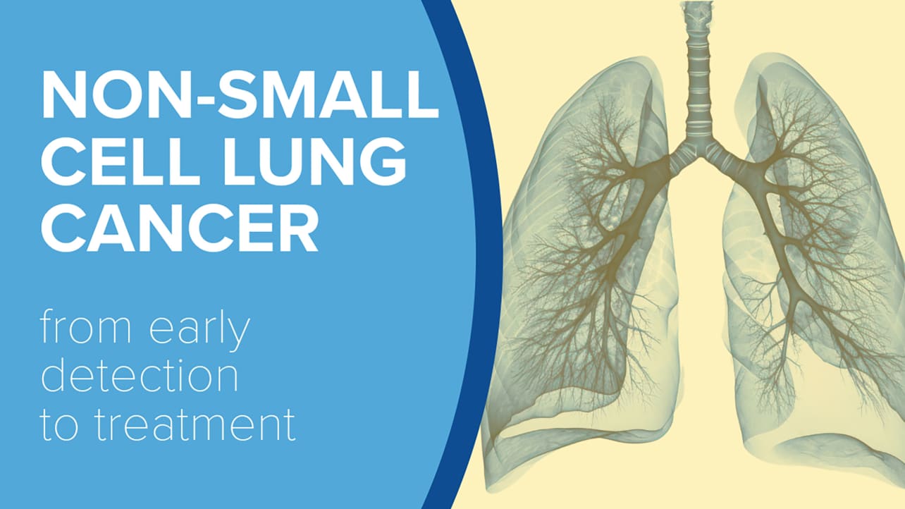 Title graphic with an image of a cross-section of human lungs on one side and text on the other that reads "Non-Small Cell Lung Cancer - from early detection to treatment"
