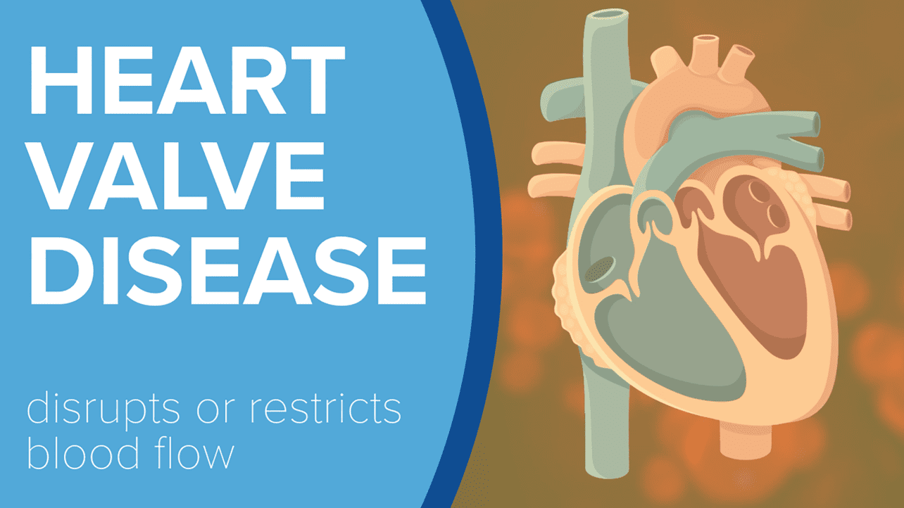 Anatomical cross section of human heart along with text that reads Heart Valve Disease disrupts or restricts blood flow