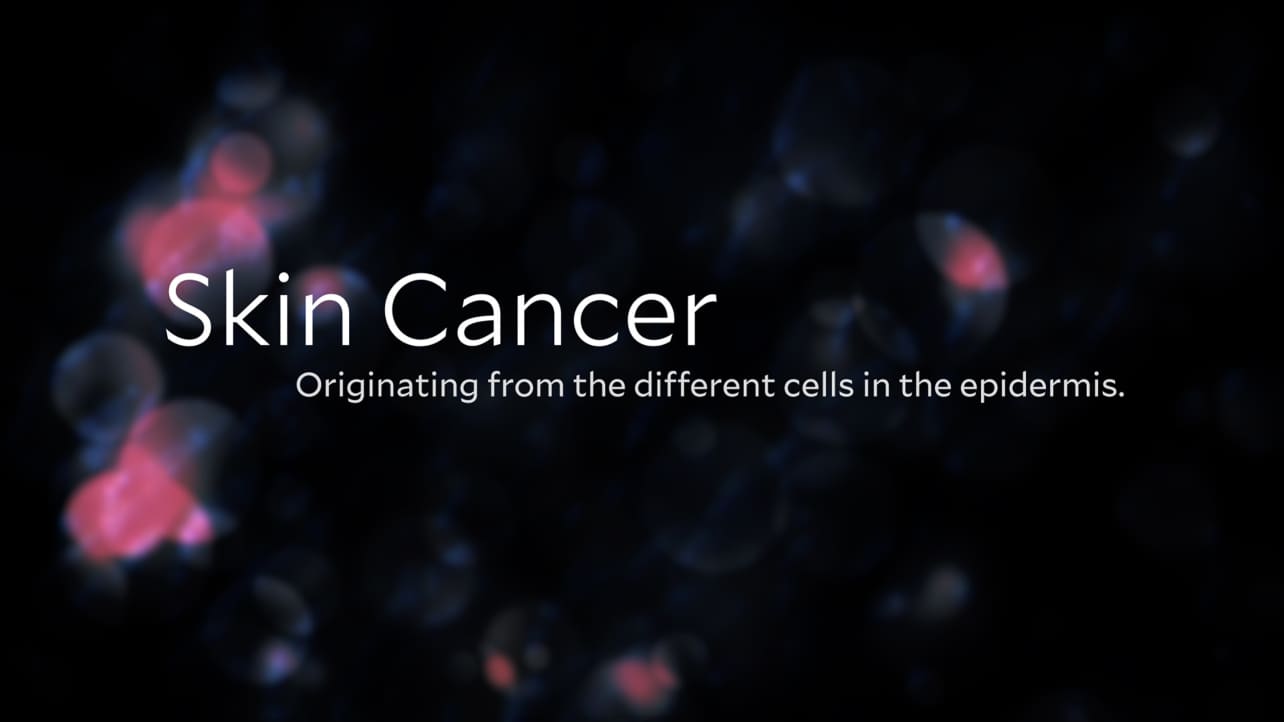 Title slide reading "skin cancer originating from the different cells in the epidermis"