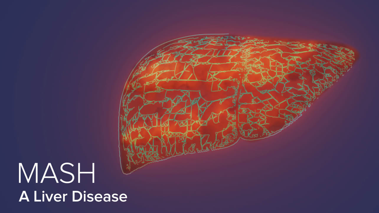 Graphic representation of a liver with a network of scarring