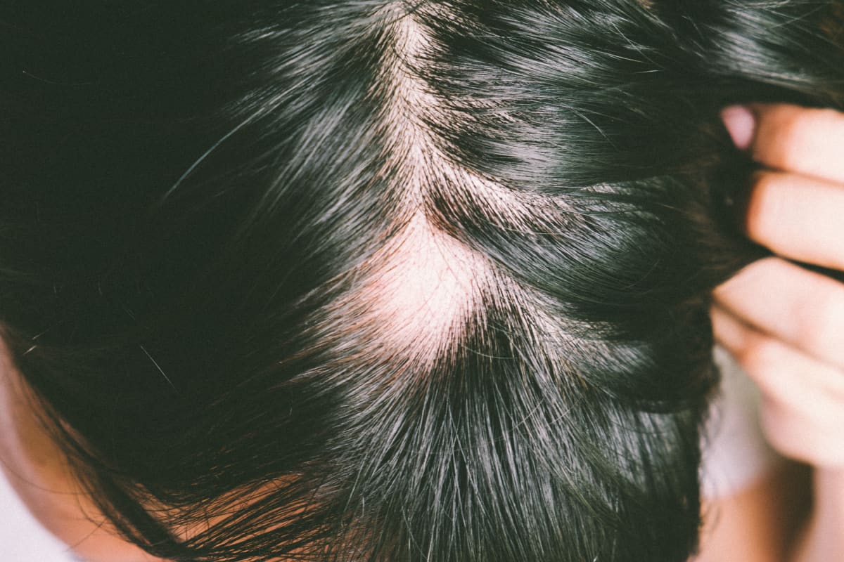 Alopecia areata cure sale