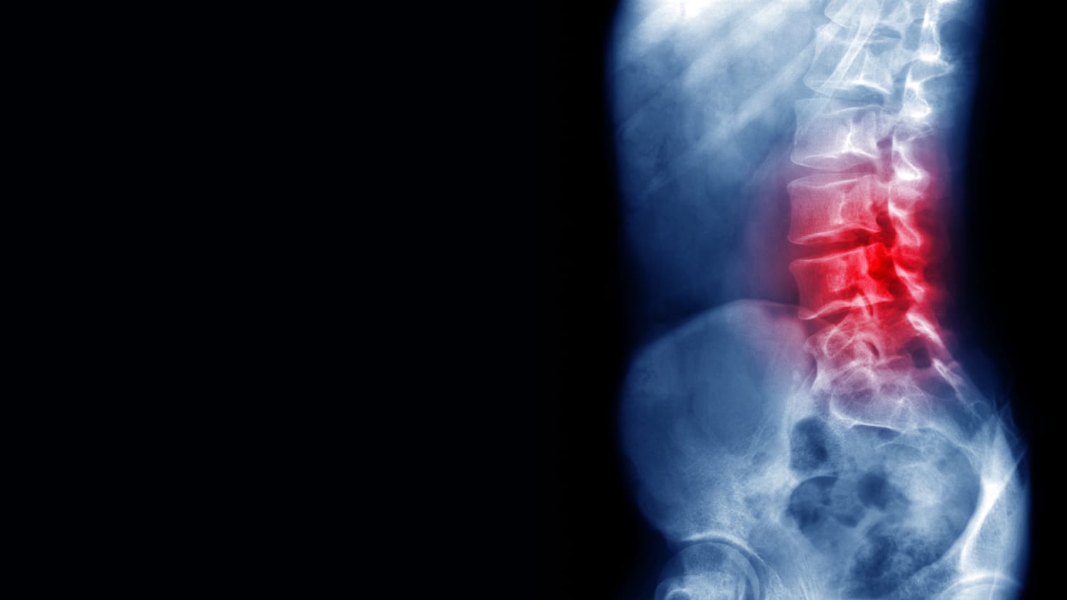 A picture of the spine showing a herniated disc