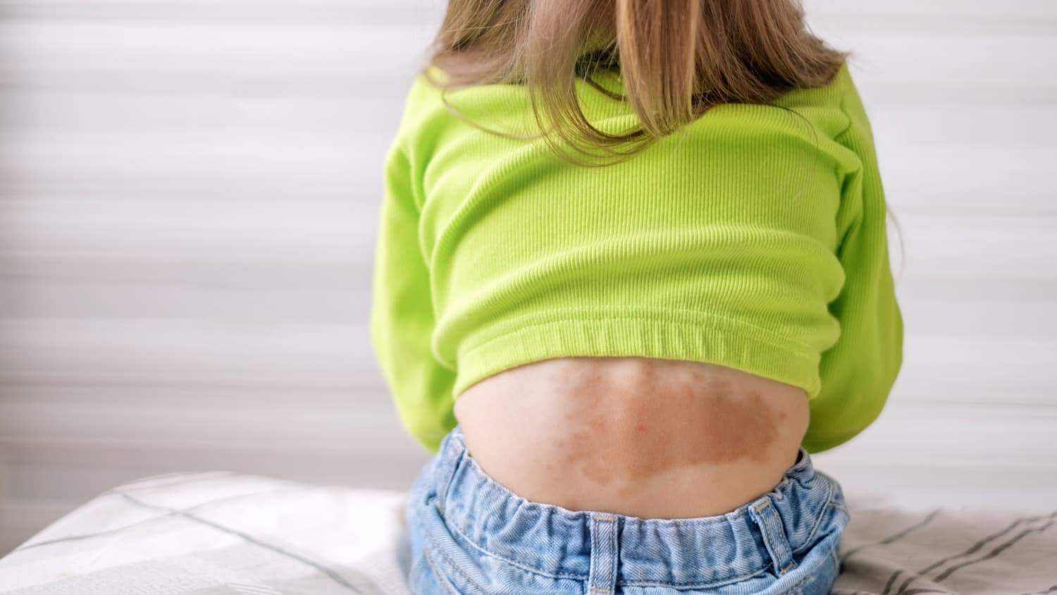 child with vascular malformation on her back
