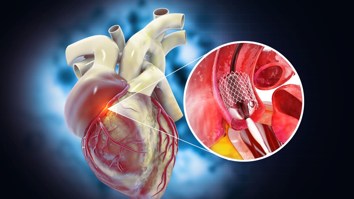 Stent in Vein by Heart