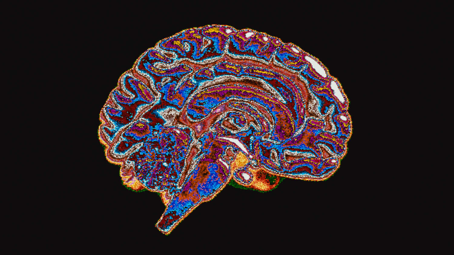 scan of a brain, representative of issues related to normal pressure hydrocephalus