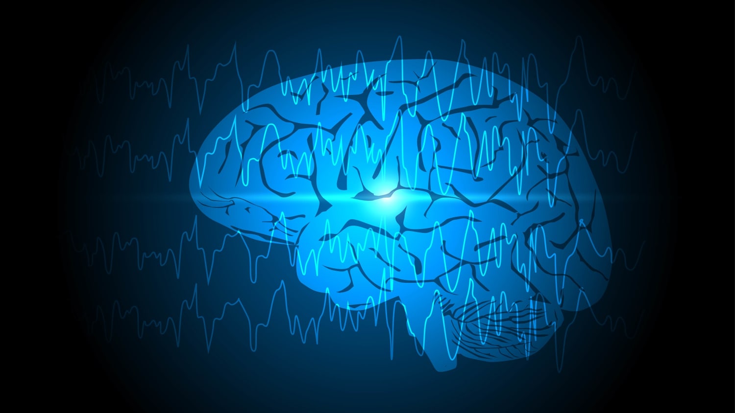 Abnormal brain waves or EEG arising from one region of brain, representing epilepsy or seizures