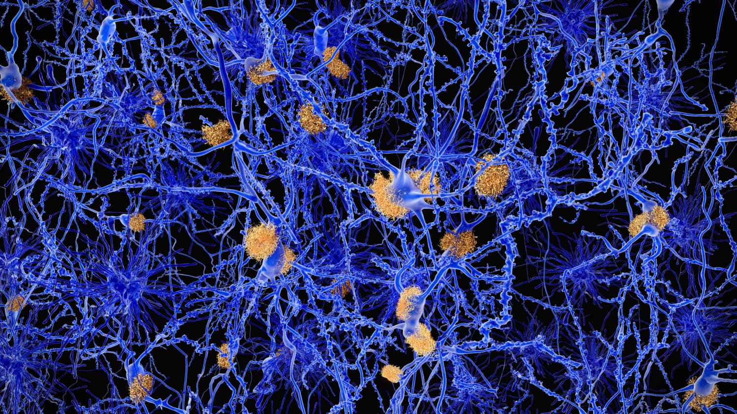 Illustration of amyloid plaques, the characteristic feature of Alzheimer’s disease, among neurons.