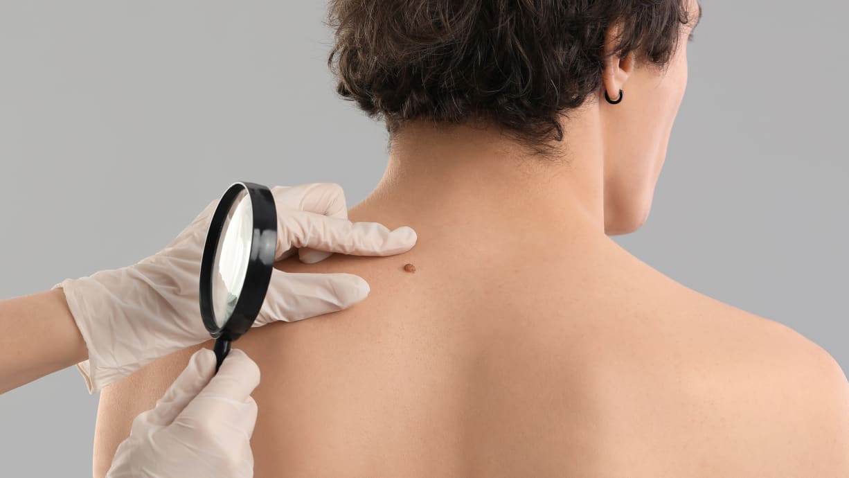 a dermatologic specialist inspecting a mole on a patient's back