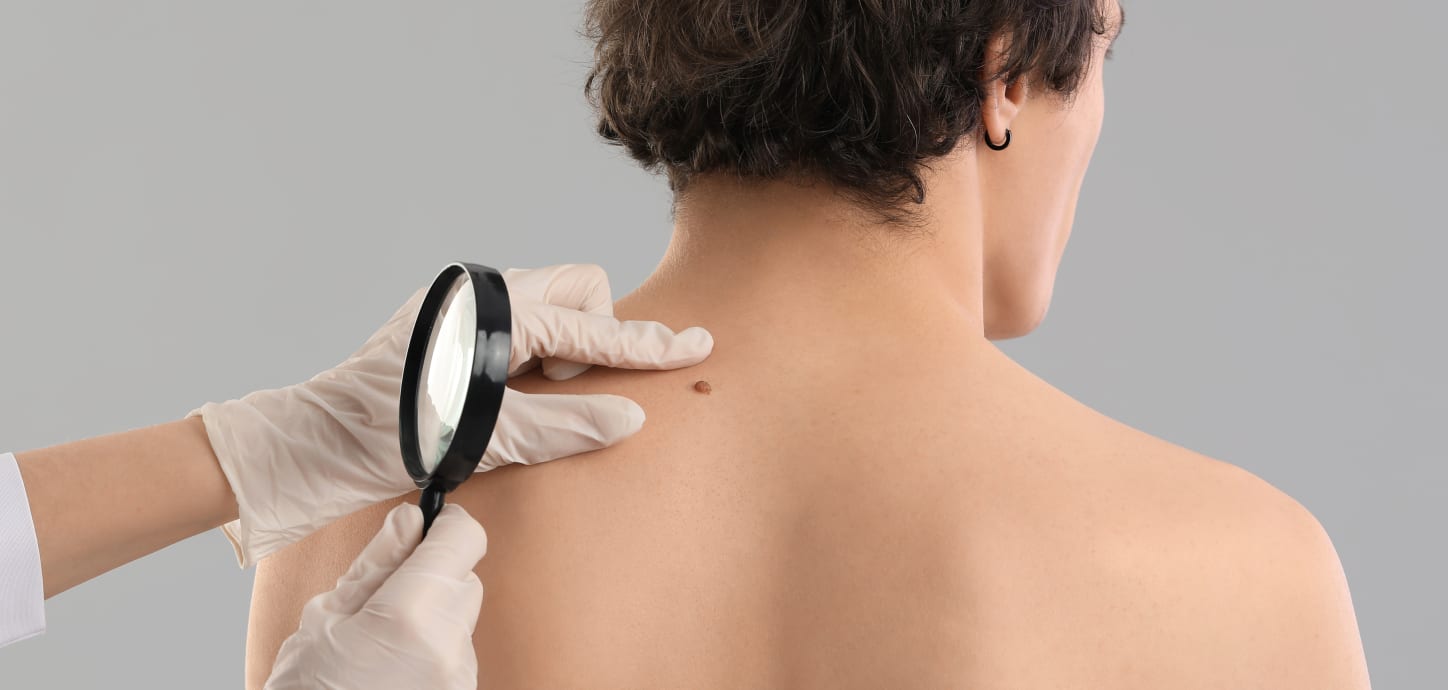 a dermatologic specialist inspecting a mole on a patient's back