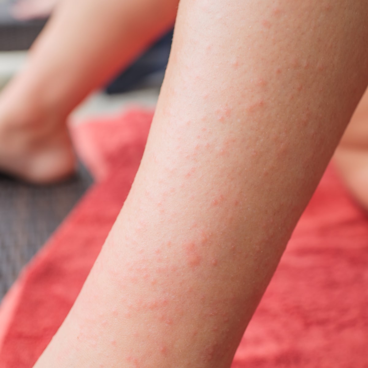 Can Cedar Cause Skin Rash? Understanding Allergic Reactions