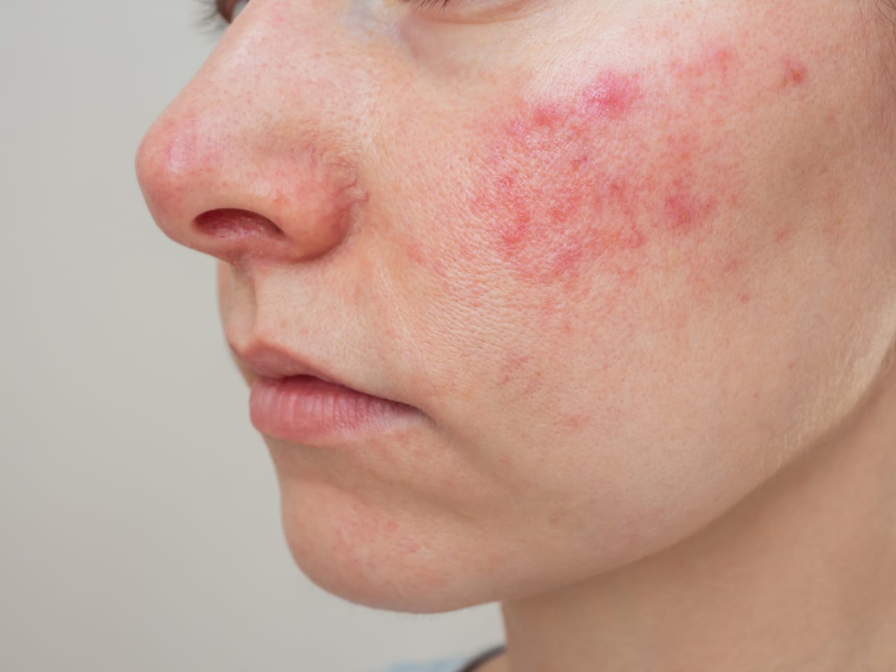 Rosacea Fact Sheets Yale Medicine