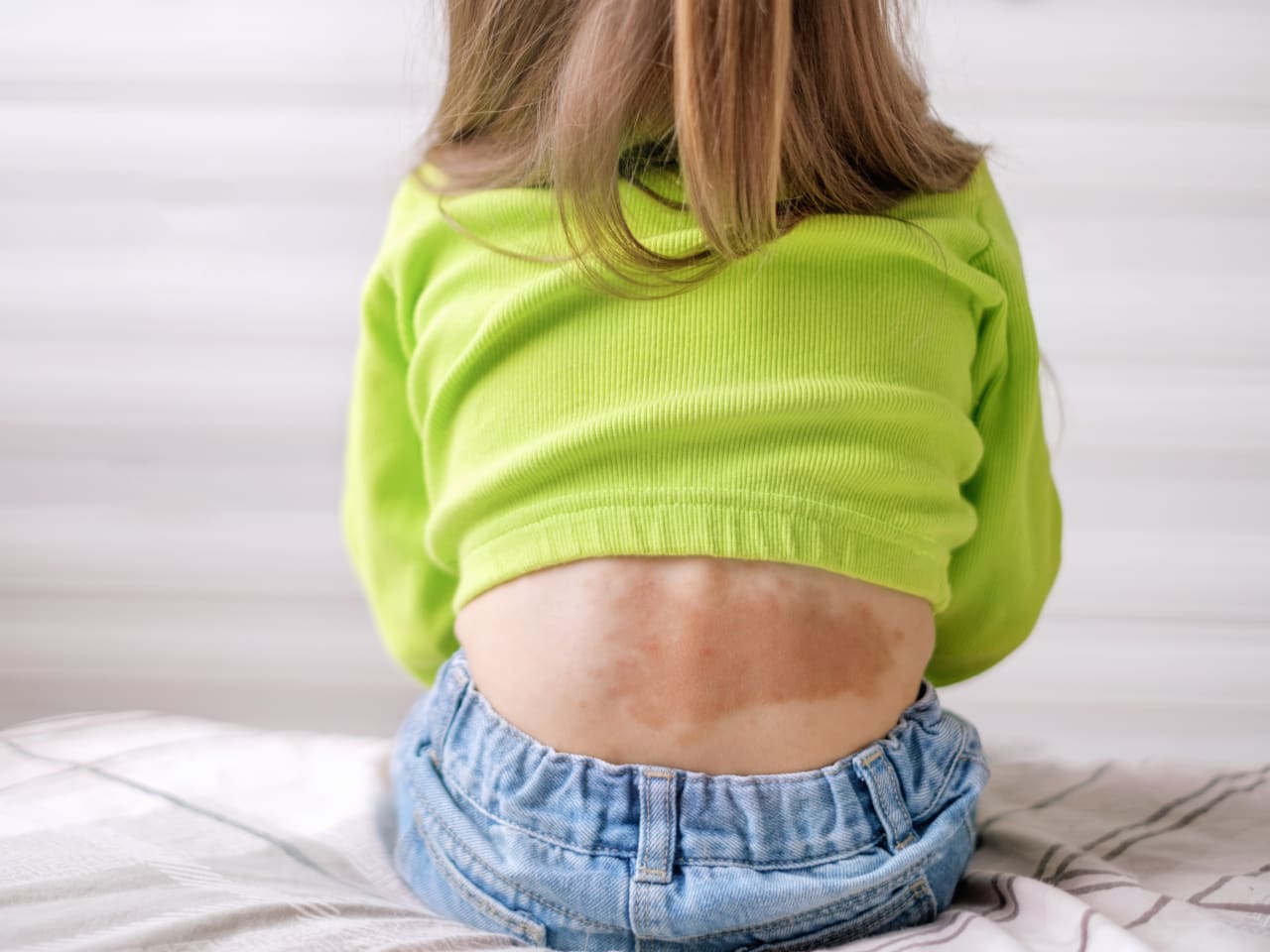 13-year-old girl chest closeup Could That Birthmark Be a Vascular Malformation? What Parents Should Know >  News > Yale Medicine