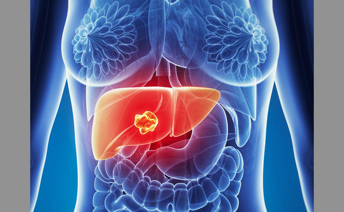 New Liver Cancer Program Launches at Smilow