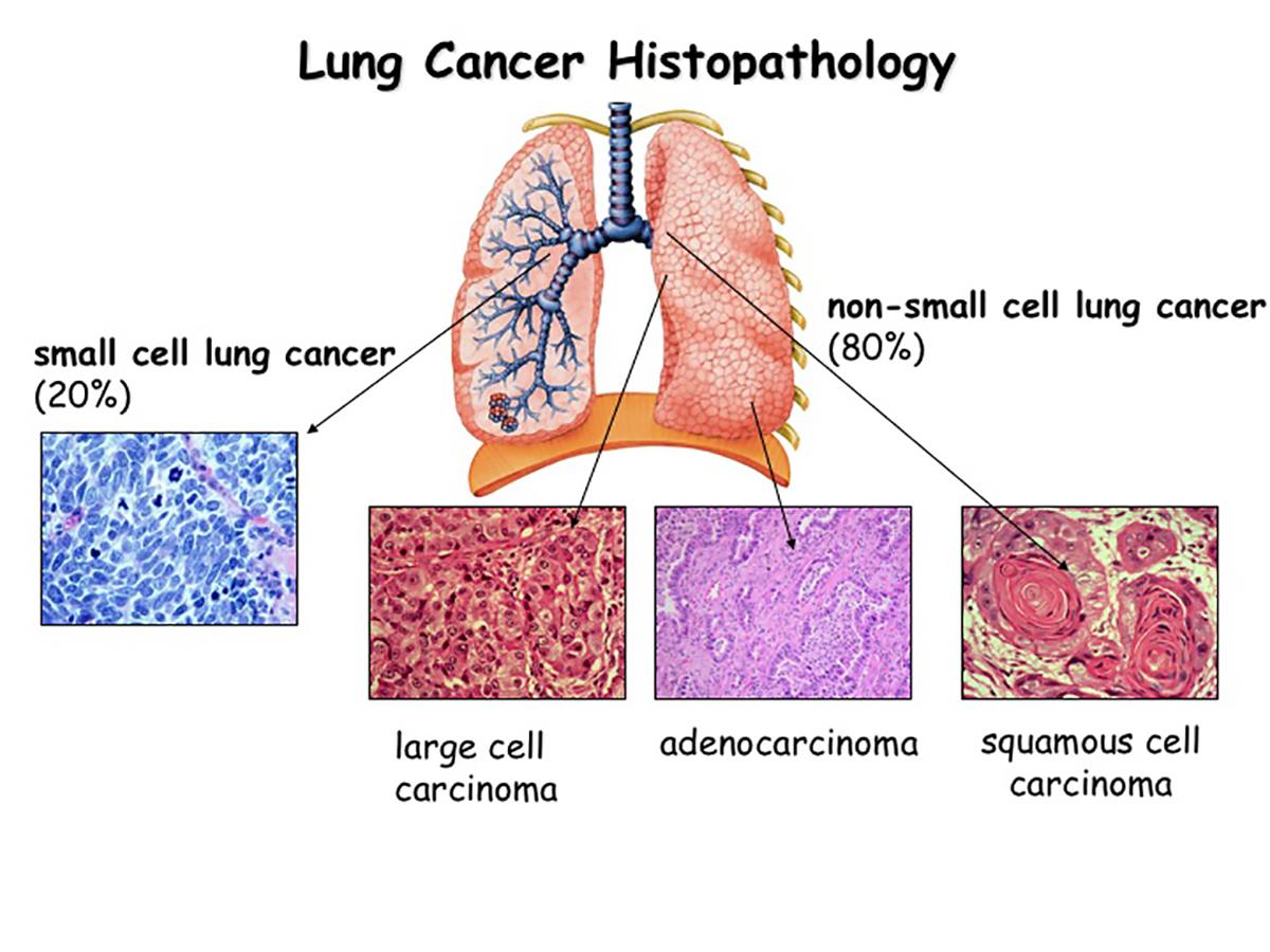 Pathogenesis Of Lung Cancer Signalling Pathways Roadm - vrogue.co