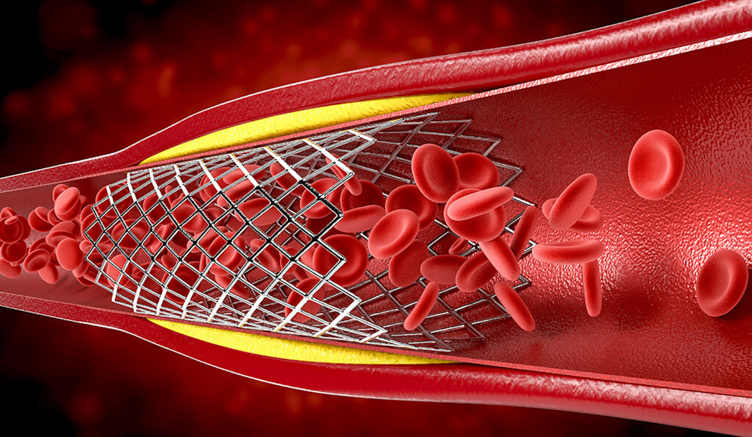 less-aggressive-treatment-better-for-heart-patients-who-go-into-shock