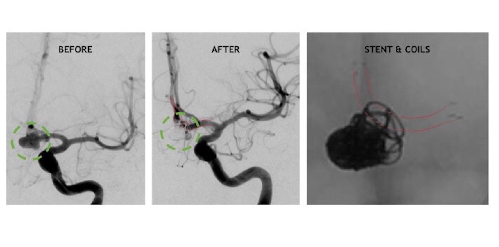 Yale vascular neurosurgeons the first in Connecticut to repair a