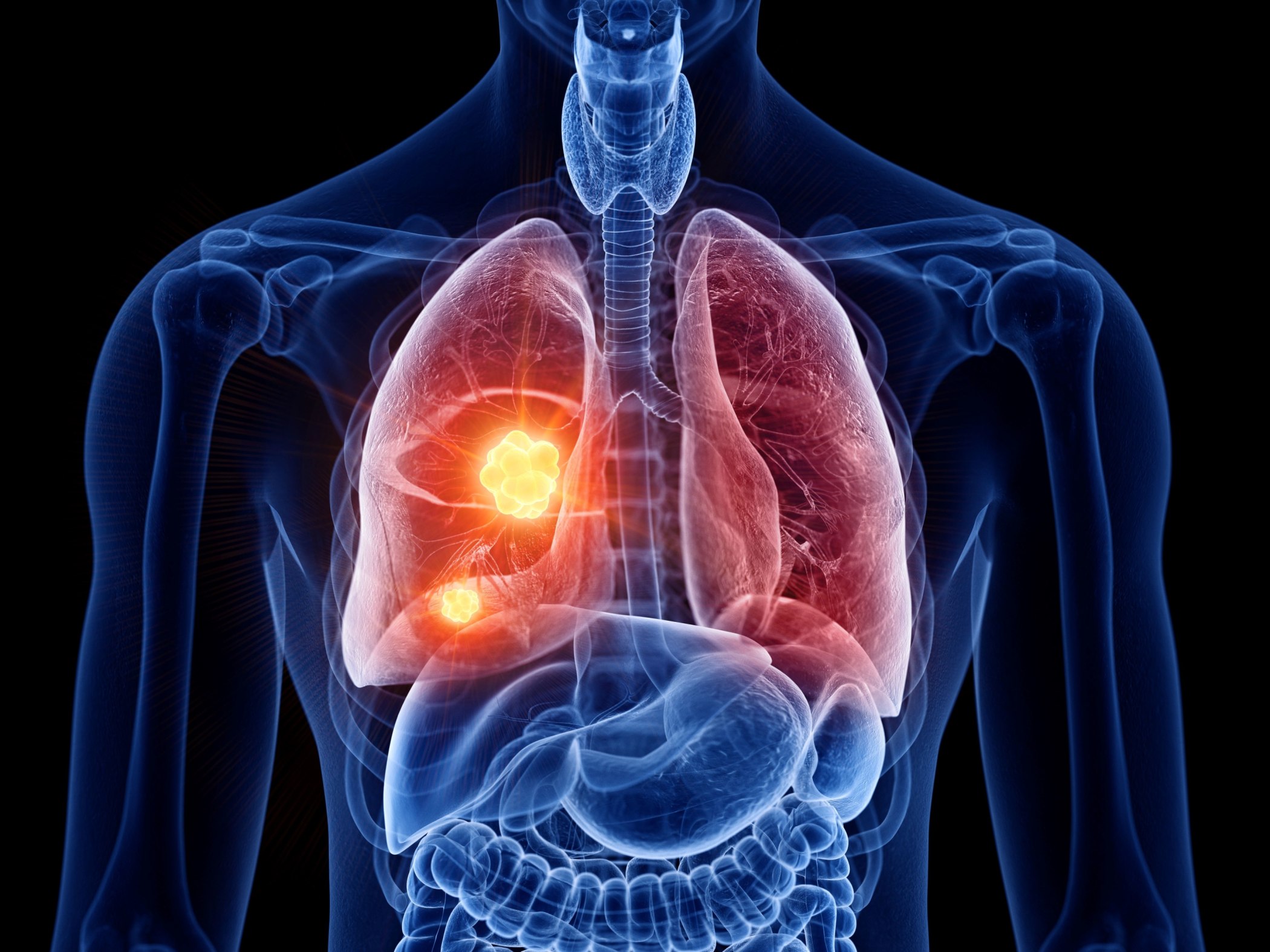 is-stage-4-lung-cancer-curable-survival-rates-treatment