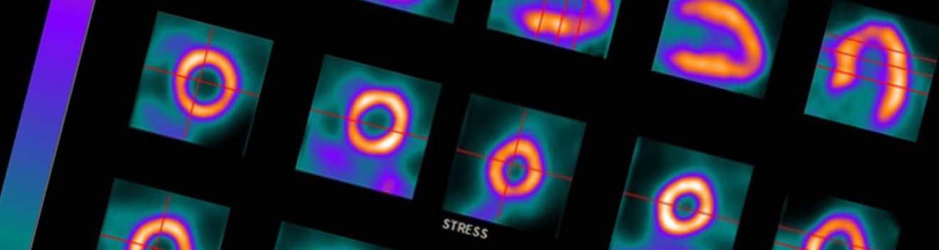 Nuclear Cardiology < Radiology & Biomedical Imaging