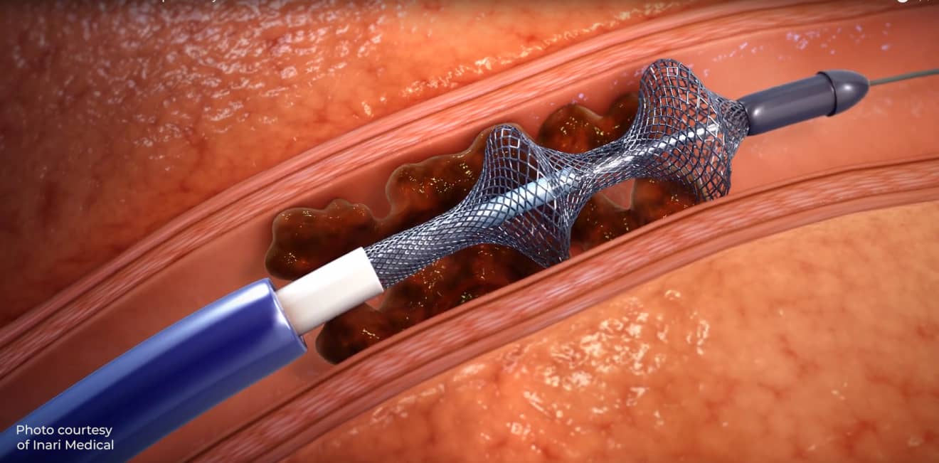 New Treatment To Remove Clots Offers Dramatic Results &lt; Yale School Of  Medicine