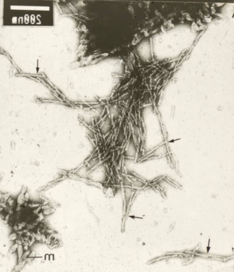 Major CJD Discoveries | Neuropathology