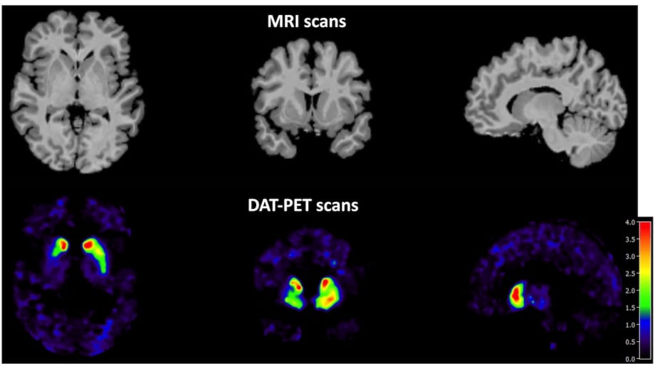 karbonade Tienerjaren aanwijzing Brain Effects of High-Intensity Exercise in Parkinson's Disease < Tinaz Lab