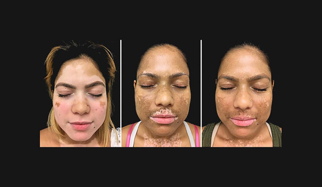 Yale dermatologists successfully restore skin color in vitiligo patients