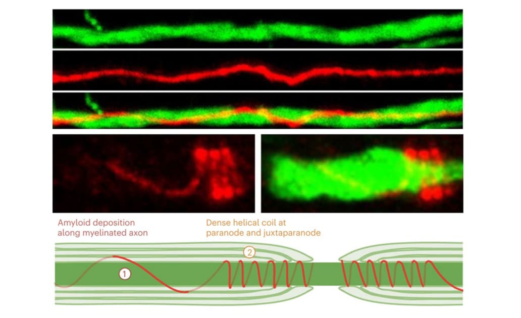 To Understand Alzheimer’s Disease, Researchers Turn to Myelin Sheath < Yale School of Medicine