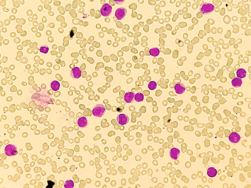 iCPSS Guides Transplant Timing for CMML Patients