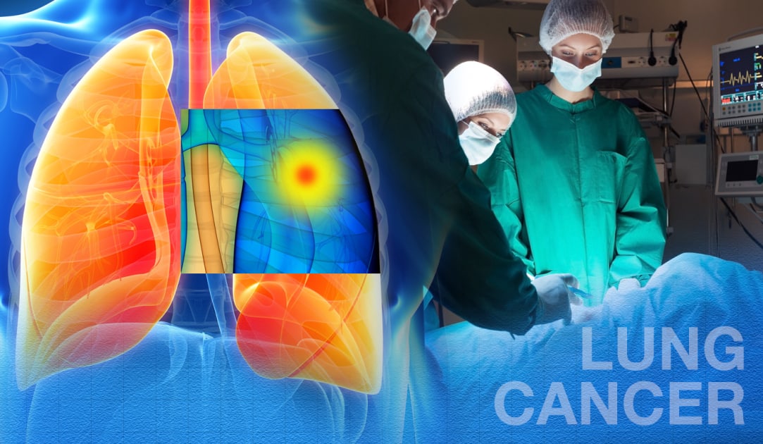 For some lung cancer patients, surgery may yield better longterm results