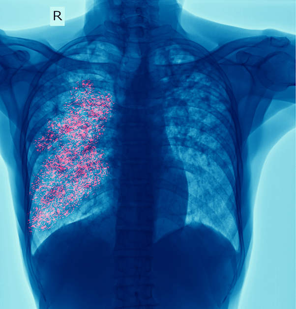 YSPH scientists show how rapid sequencing could transform tuberculosis care