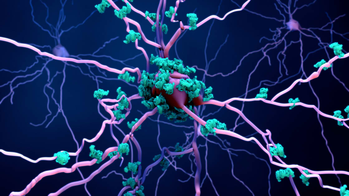 Parkinson’s Disease Associated With Neuroinflammation in the Brain, New