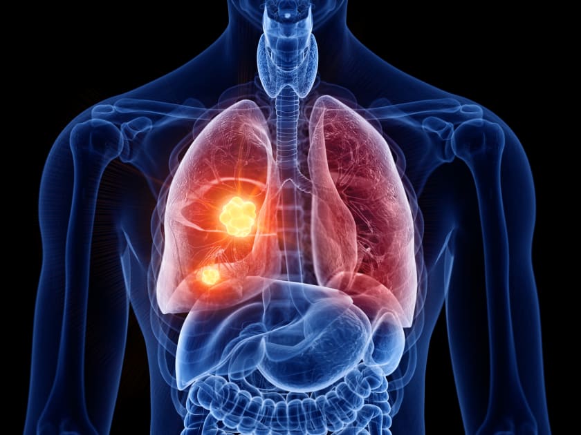 More Accurate Prognosis for Lung Cancer Possible With New Test, Study Shows < Internal Medicine