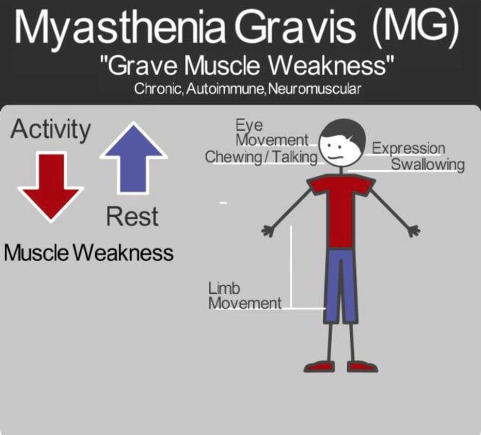 Featured Research Improving Treatment for Myasthenia Gravis