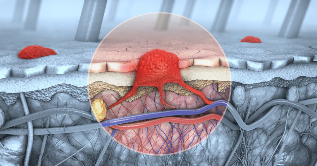 Unexpected Findings in Study of T Cells Considered Front-Line Fighters Against Advanced Melanoma