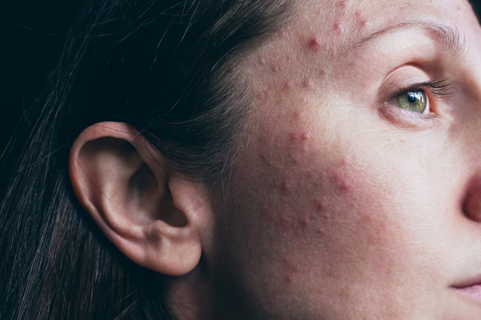 antibiotics-for-acne-groundbreaking-study-shows-why-one-works-best