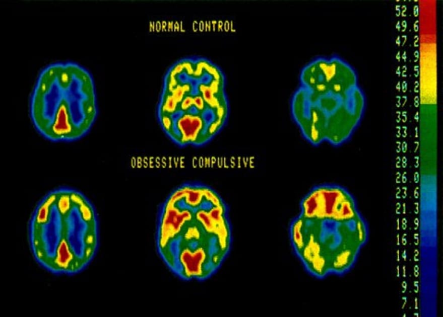 fMRI vs. SPECT Scan for the Brain