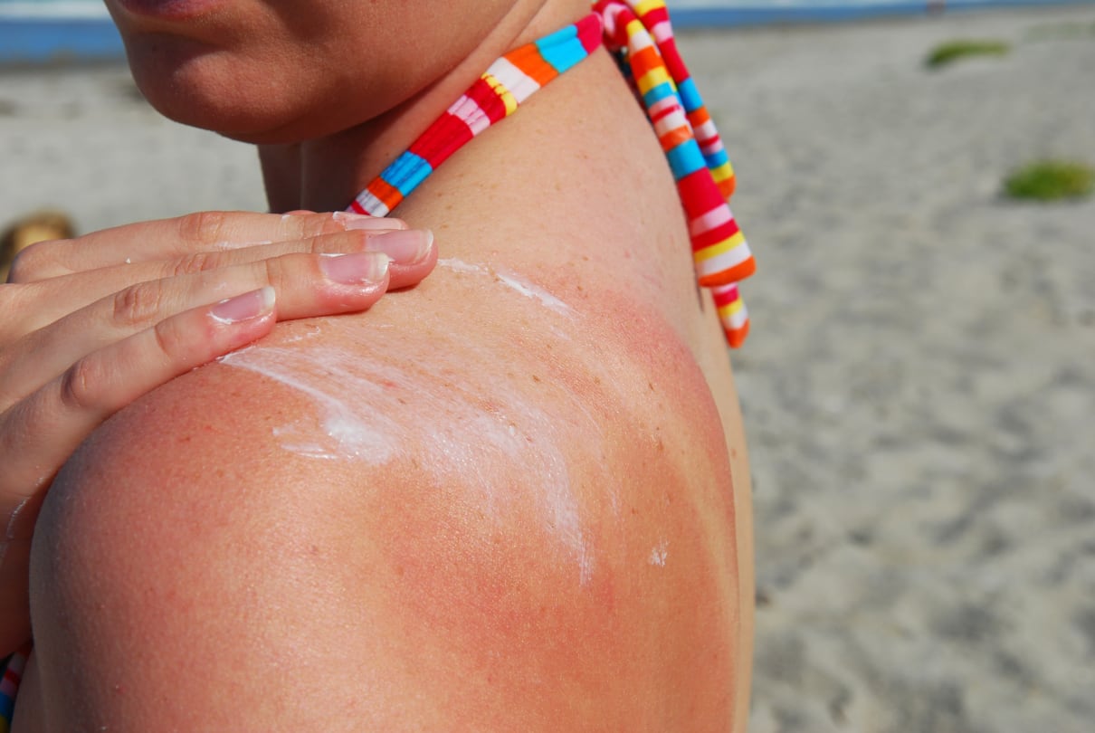 Sunburn and sun protection - treatments and prevention including sunscreen