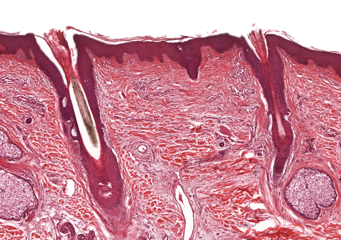Skin Biopsies: What You Should Expect &gt; News &gt; Yale Medicine