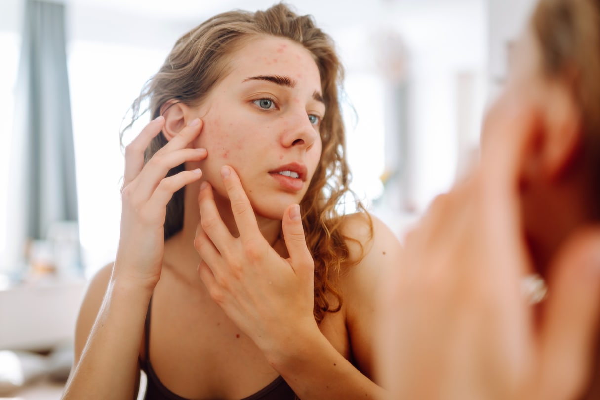 Effective Home Solutions for Acne: Science-Backed Insights