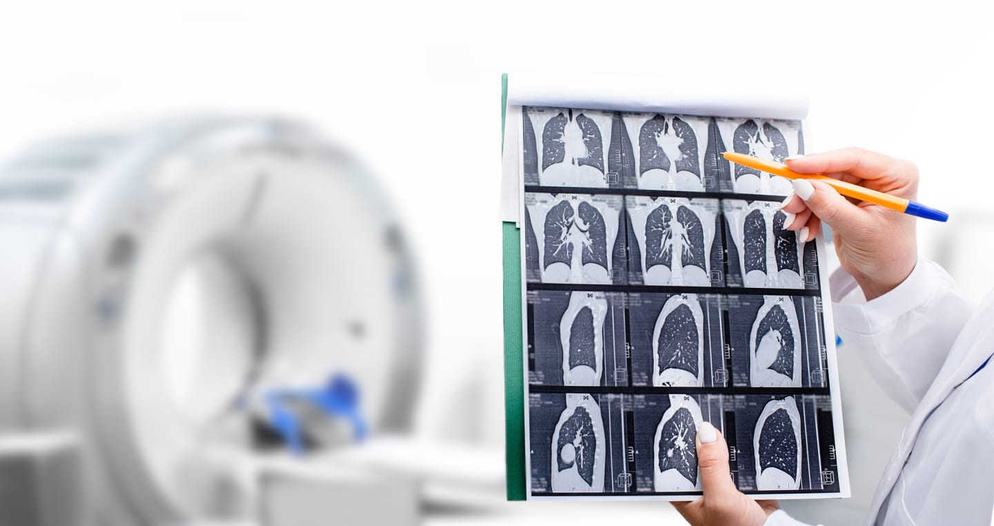 3 Things to Know About Lung Cancer Screening > News > Yale Medicine