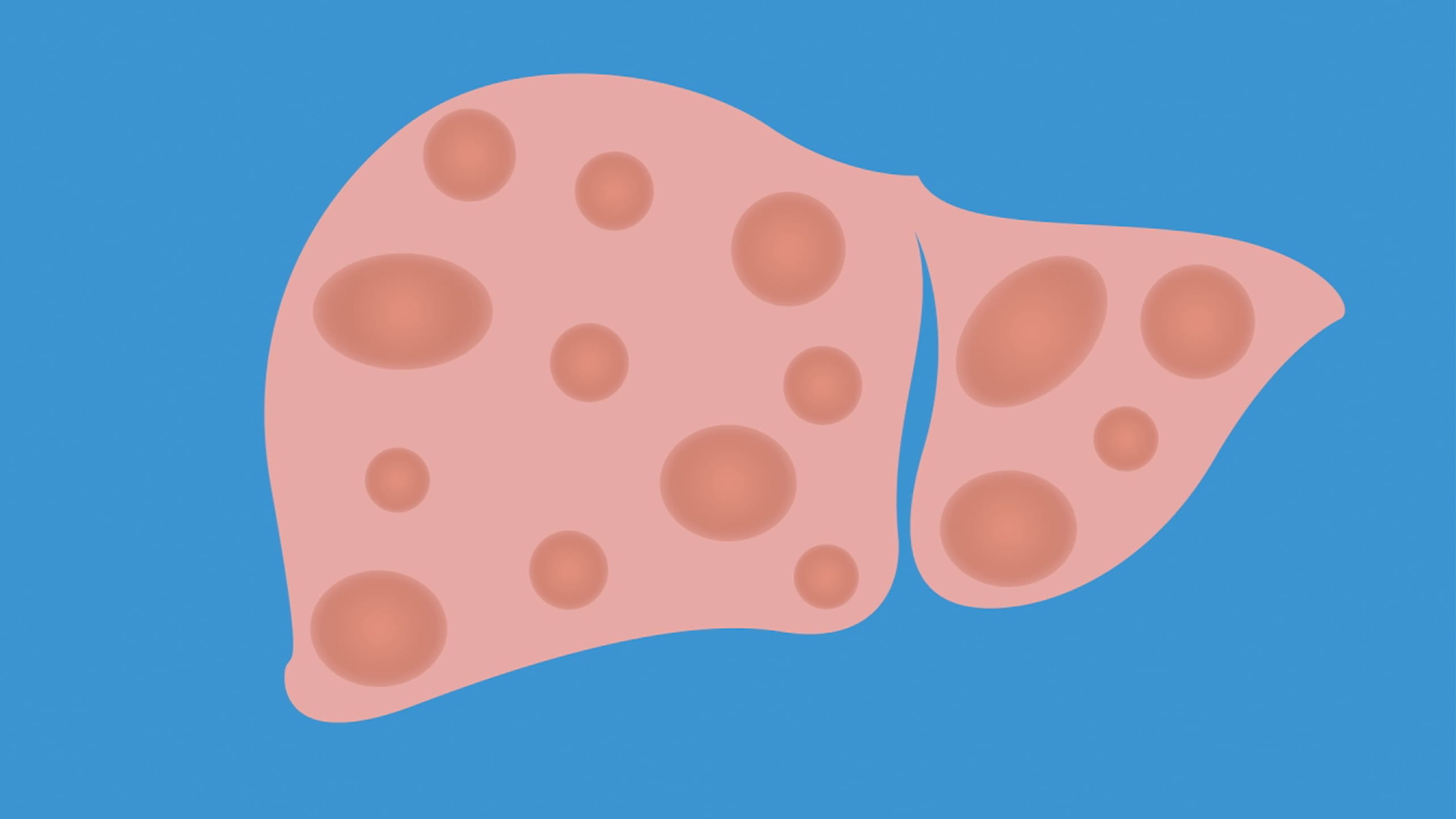 An illustration of a liver with fatty liver disease.