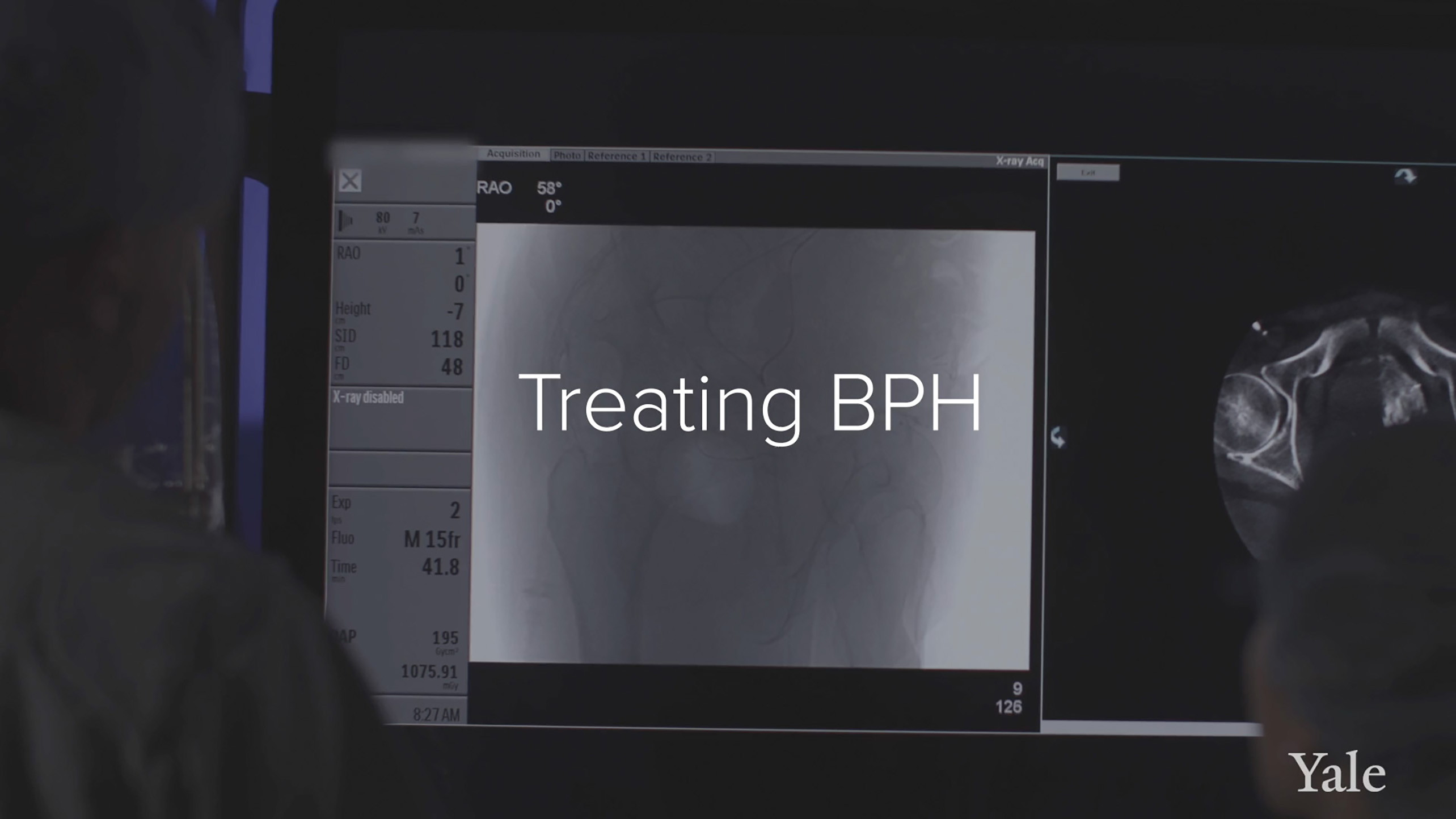 Poster for video prostatic_artery_embolization__a_minimally_invasive_treatment_for_bph (1080p)