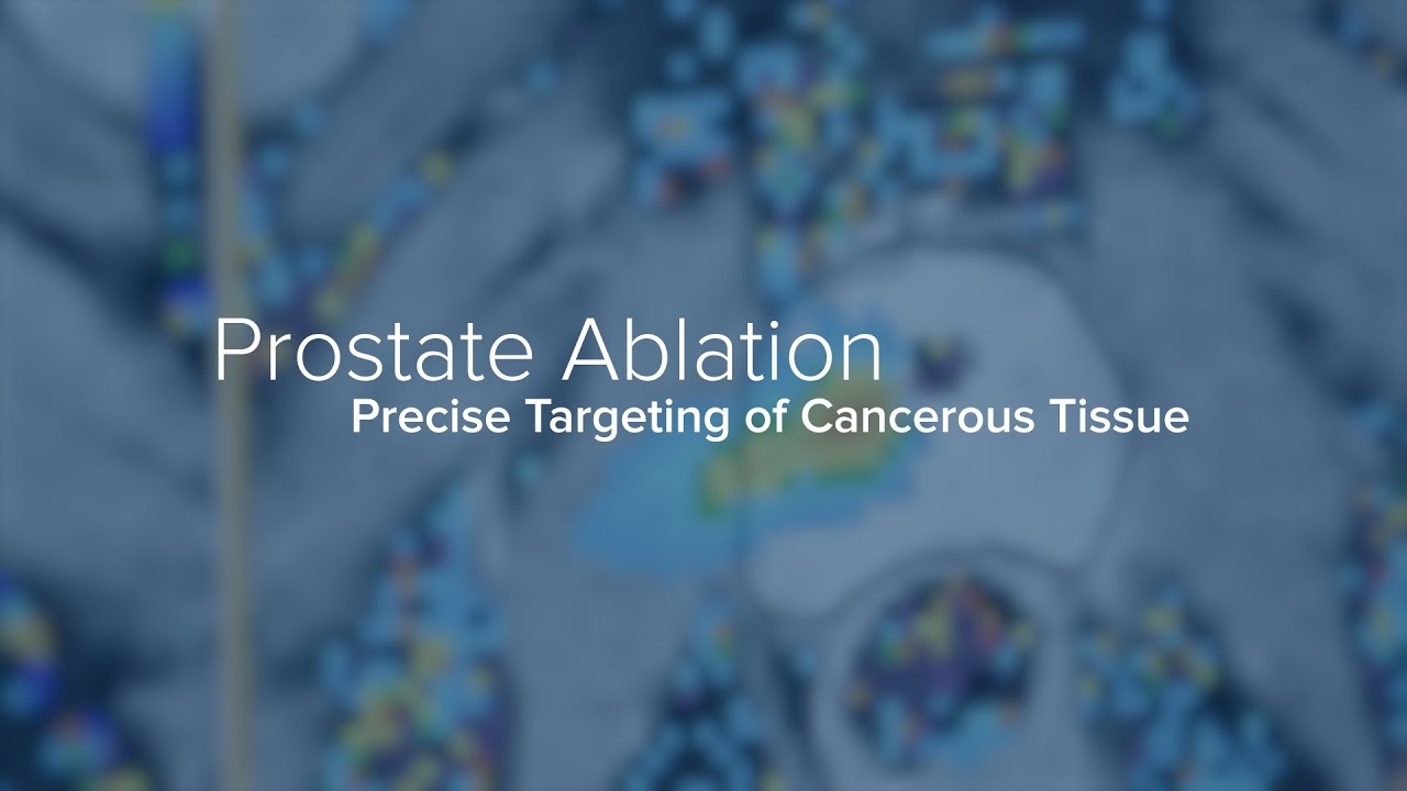 Poster for video How Prostate Cancer is Treated With Ablation - Yale Medicine Explains