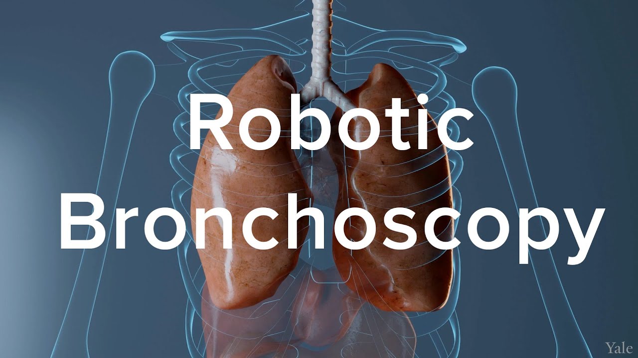 Poster for video Robotic Bronchoscopy: Precision in Lung Cancer Diagnosis