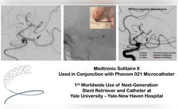 Yale Stroke Team The 1st Worldwide To Treat Acute Stroke With A